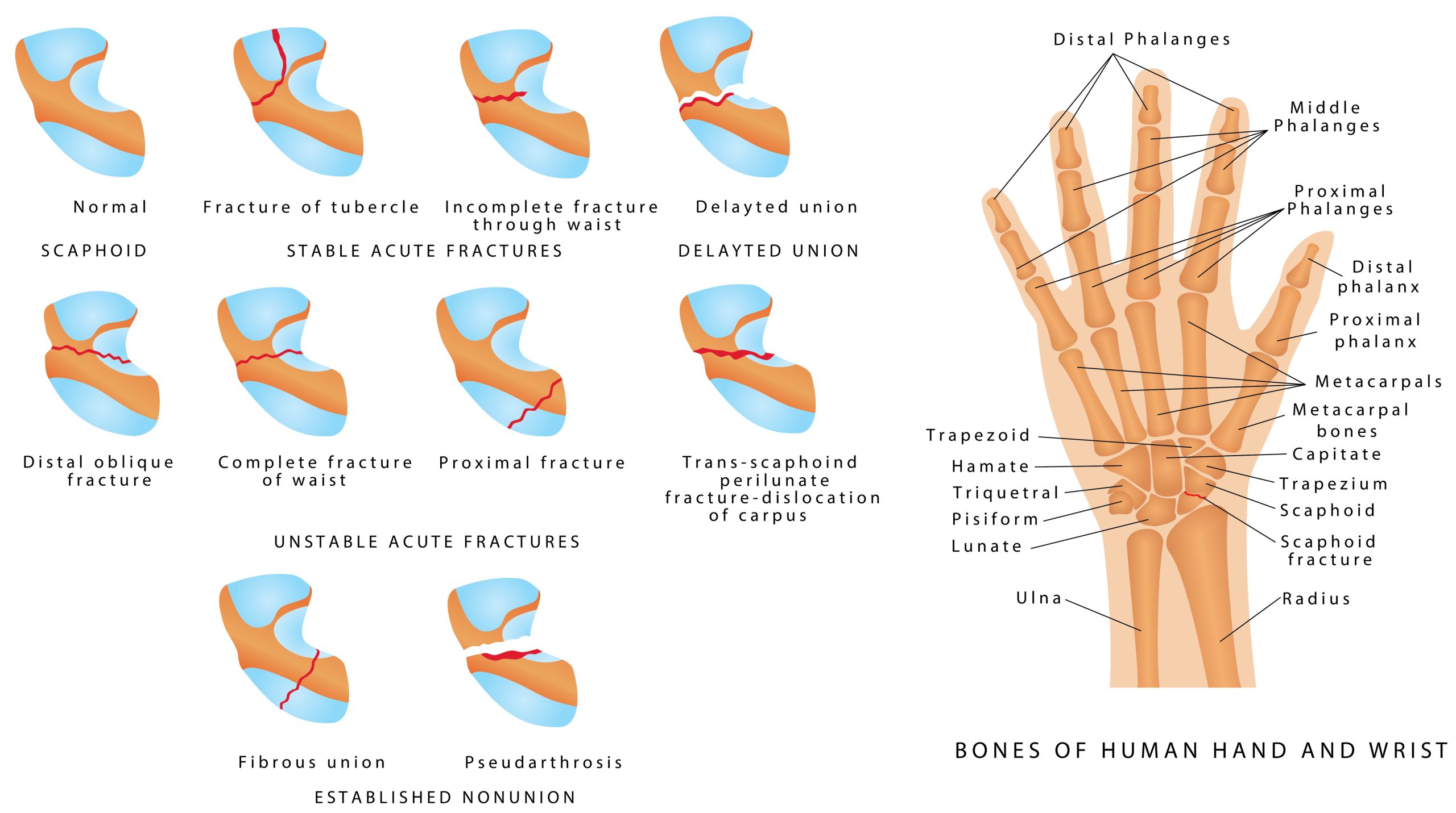 Katranji Hand Center|Scaphoid Fracture