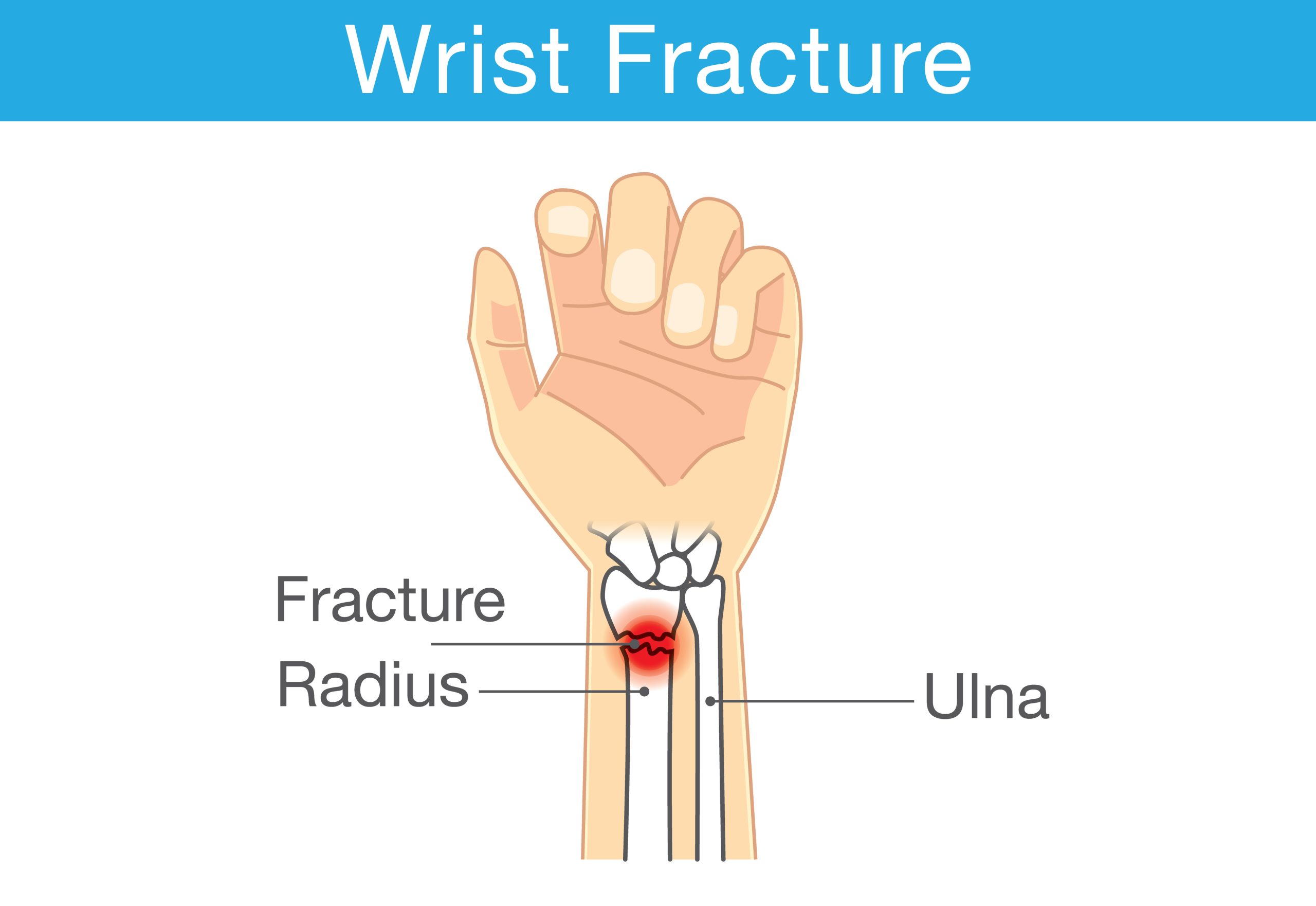 Katranji Hand Center|Wrist Fracture